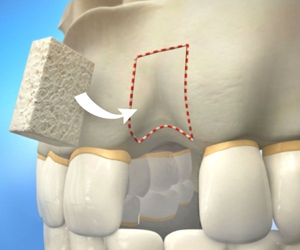 Illustration of bone graft