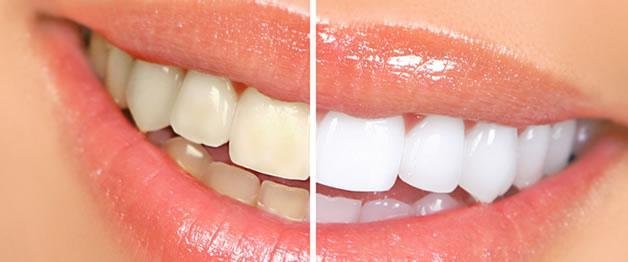 aurora teeth whitening