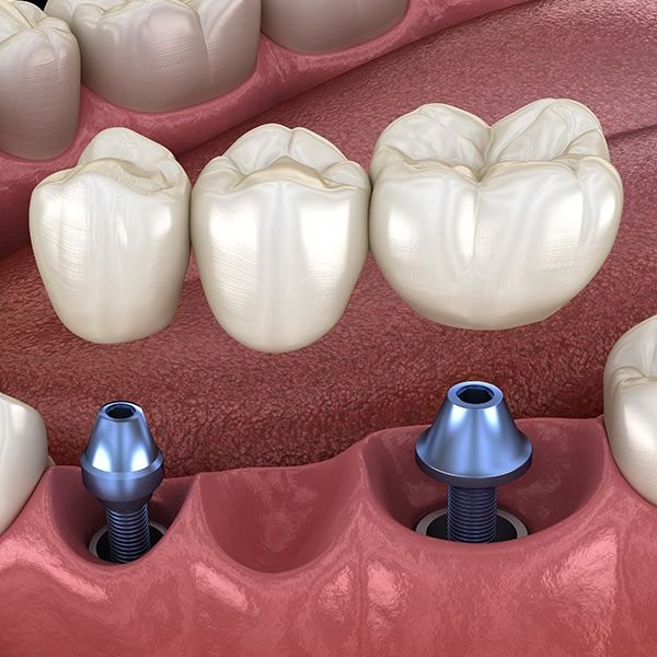 Dental Bridges