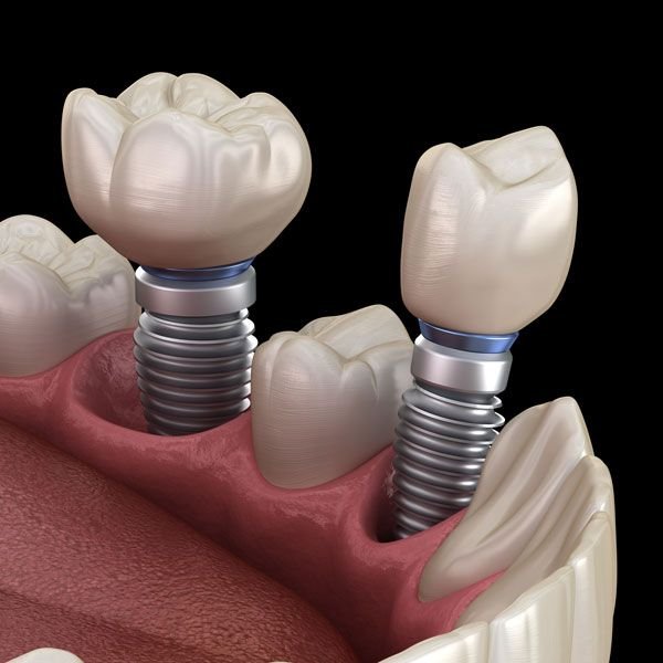 Implant crowns