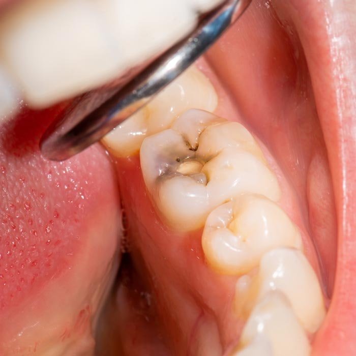 Decayed Tooth