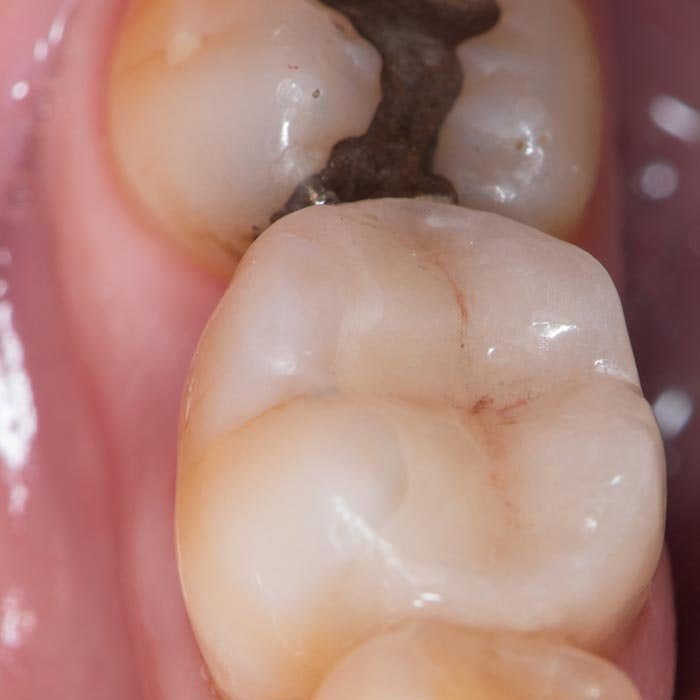 Tooth with Composite Amalgam Filling