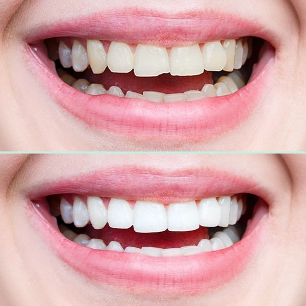 Before and after dental bonding